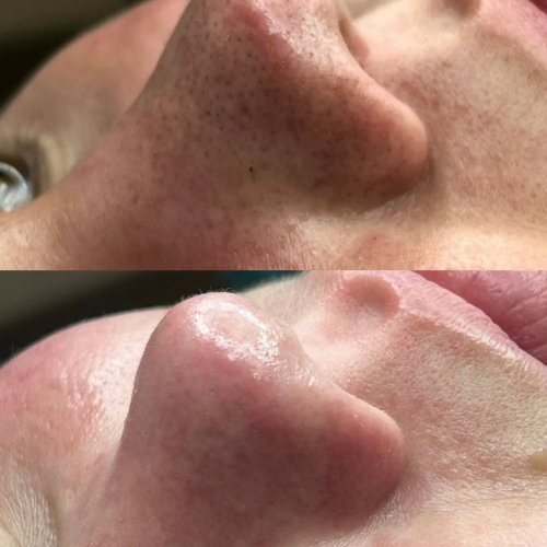 Ultrasonic Skin Renewer Scrubber