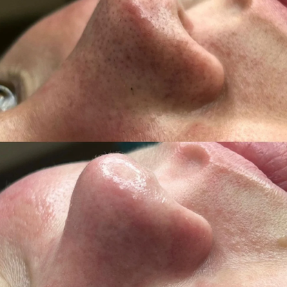 Ultrasonic Skin Renewer Scrubber